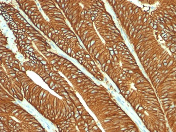 Formalin-fixed, paraffin-embedded human colon carcinoma stained with EpCAM Mouse Monoclonal Antibody (MOC-31).