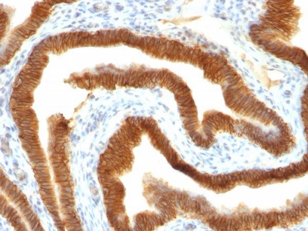 Formalin-fixed, paraffin-embedded human ovarian carcinoma stained with EpCAM Mouse Monoclonal Antibody (MOC-31).