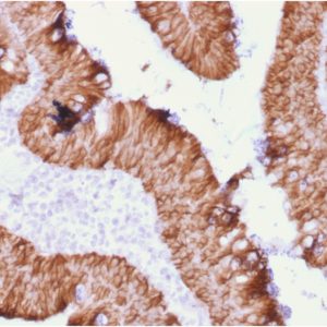 Formalin-fixed, paraffin-embedded human rectal massstained with EpCAM Recombinant Mouse Monoclonal Antibody (rEGP40/1372).