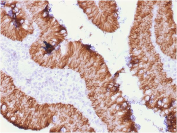 Formalin-fixed, paraffin-embedded human rectal massstained with EpCAM Recombinant Mouse Monoclonal Antibody (rEGP40/1372).
