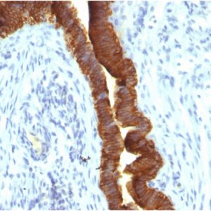 Formalin-fixed, paraffin-embeddedhuman ovarian carcinoma stained with EpCAM Mouse Recombinant Monoclonal Antibody (rEGP40/1110).