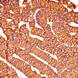 Formalin-fixed, paraffin-embedded human Colon Carcinoma stained with Ep-CAM Ab (SPM528).