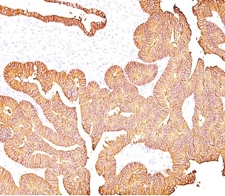 Formalin-fixed, paraffin-embedded human colon carcinoma stained with EpCAM / CD326 Mouse Monoclonal Antibody (323/A3). HIER: Tris/EDTA, pH9.0, 45min. 2°C: HRP-polymer, 30min. DAB, 5min.