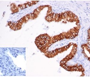 Formalin-fixed, paraffin-embeddedhumanprostate carcinoma stained with EpCAM Recombinant Mouse Monoclonal Antibody (rEGP40/826). Inset: PBS instead of primary antibody, secondary negative control.