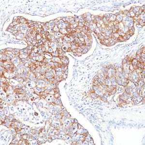 Formalin-fixed, paraffin-embedded human Breast Carcinoma stained with Ep-CAM Mouse Monoclonal Antibody (Ber-EP4)