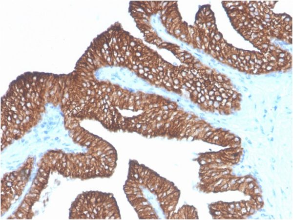 Formalin-fixed, paraffin-embedded human Prostate Carcinoma stained with Ep-CAM Mouse Monoclonal Antibody (Ber-EP4)