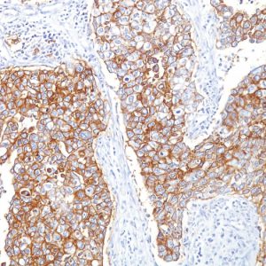 Formalin-fixed, paraffin-embedded human Breast Carcinoma stained with Ep-CAM Mouse Monoclonal Antibody (HEA125).