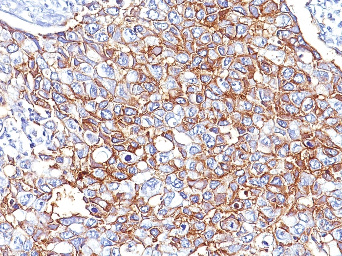 Formalin-fixed, paraffin-embedded human Breast Carcinoma stained with EpCAM Mouse Monoclonal Antibody (EGP40/826). Ep-CAM / CD326 (Extracellular Domain) (Epithelial Marker) Antibody