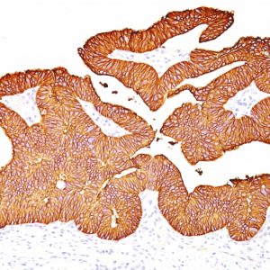 Formalin-fixed, paraffin-embedded human Colon Carcinoma stained with EpCAM Mouse Monoclonal Antibody (EGP40/837).