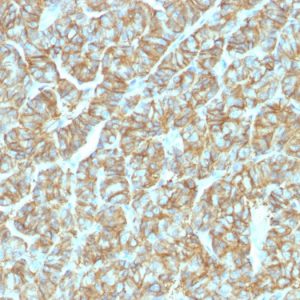 Formalin-fixed, paraffin-embedded human thyroid carcinoma stained with EpCAM Recombinant Rabbit Monoclonal Antibody (EGP40/1555R).