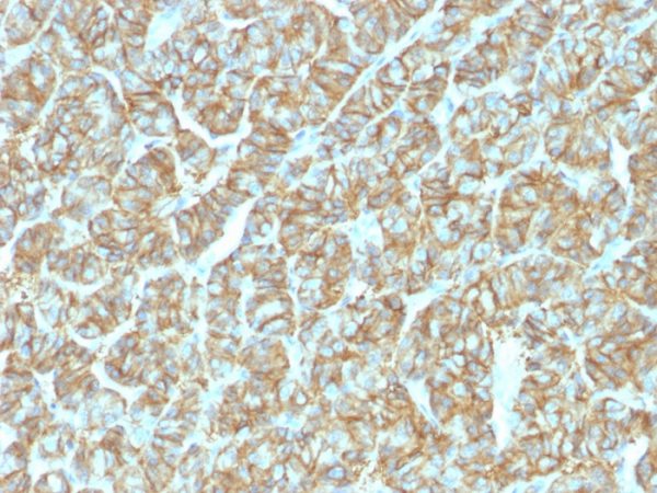 Formalin-fixed, paraffin-embedded human thyroid carcinoma stained with EpCAM Recombinant Rabbit Monoclonal Antibody (EGP40/1555R).
