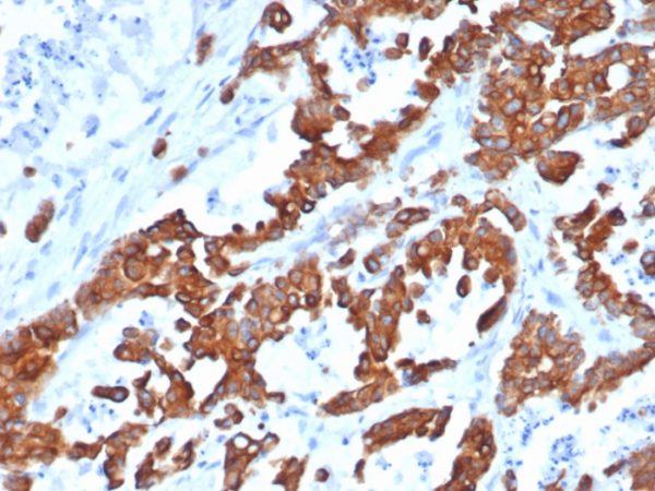 Formalin-fixed, paraffin-embedded human prostate carcinoma stained with EpCAM Recombinant Rabbit Monoclonal Antibody (EGP40/1555R).