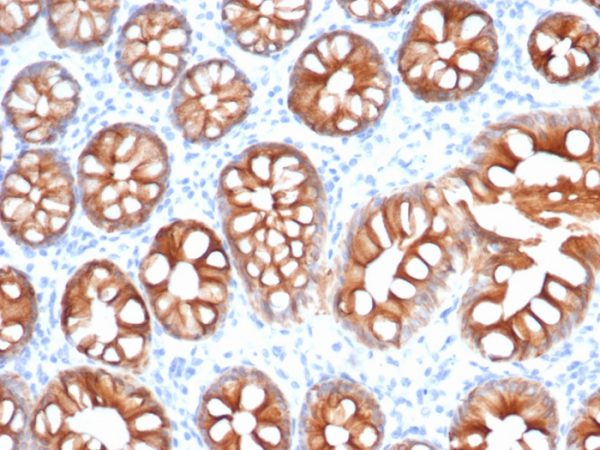 Formalin-fixed, paraffin-embedded human colon carcinoma stained with EpCAM Recombinant Rabbit Monoclonal Antibody (EGP40/1555R).