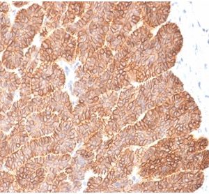 Formalin-fixed, paraffin-embedded human basal cell carcinoma stained with EpCAM Recombinant Rabbit Monoclonal Antibody (EGP40/2041R).