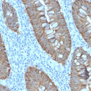Formalin-fixed, paraffin-embedded human Colon Carcinoma stained with EpCAM Rabbit Recombinant Monoclonal Antibody (EGP40/2571R).