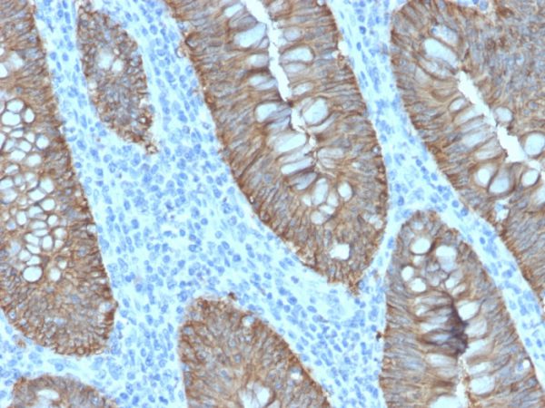 Formalin-fixed, paraffin-embedded human Colon Carcinoma stained with EpCAM Rabbit Recombinant Monoclonal Antibody (EGP40/2571R).