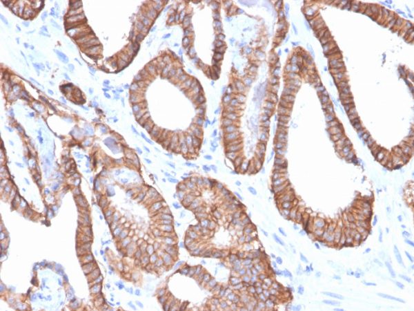 Formalin-fixed, paraffin-embedded human Prostate Carcinoma stained with EpCAM Rabbit Recombinant Monoclonal Antibody (EGP40/2571R).