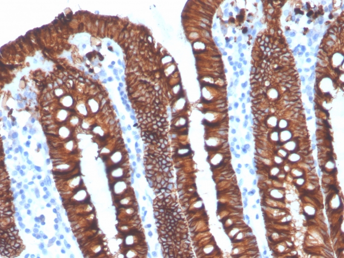 Formalin-fixed, paraffin-embedded human ovarian carcinoma stained with EpCAM Recombinant Rabbit Monoclonal Antibody (EGP40/4546R). Recombinant EpCAM / CD326 (Epithelial Marker) Antibody - Image 2