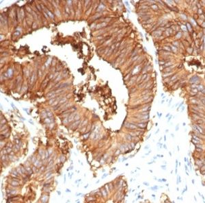 Formalin-fixed, paraffin-embedded human colon stained with EpCAM Rabbit Recombinant Monoclonal Antibody (EGP40/7035R). HIER: Tris/EDTA, pH9.0, 45min. 2 °: HRP-polymer, 30min. DAB, 5min.