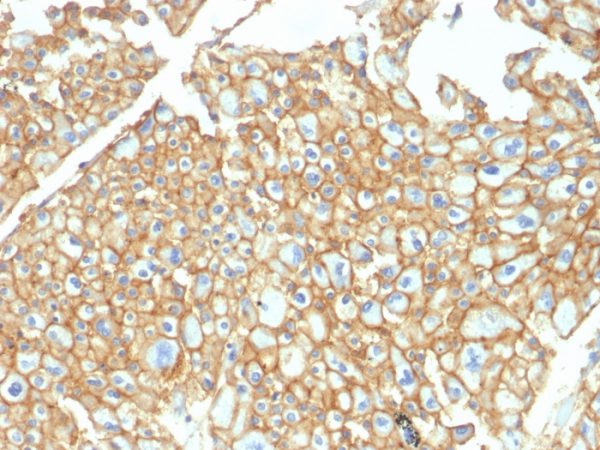Formalin-fixed, paraffin-embedded human Renal Cell Carcinoma stained with EpCAM Rabbit Polyclonal Antibody.