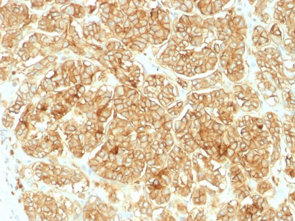 Formalin-fixed, paraffin-embedded human Renal Cell Carcinoma stained with EpCAM Rabbit Polyclonal Antibody.