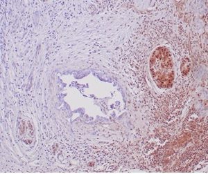 Immunohistochemical stain using SMAD4/6309R showing loss of SMAD4 expression in pancreatic ductal adenocarcinoma. Note adjacent benign ductal epithelium and  background stroma as internal control showing positive / retained SMAD4 staining.
