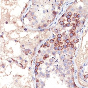 Formalin-fixed, paraffin-embedded human Testicular Carcinoma stained with MAGE-1 Mouse Monoclonal Antibody (MA454).
