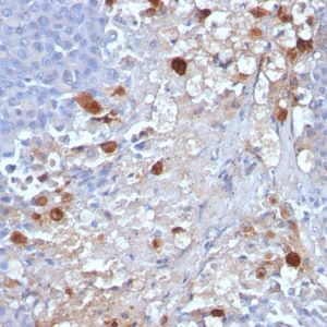 Formalin-fixed, paraffin-embedded human Melanoma stained with MCAM Mouse Monoclonal Antibody (MCAM/1101).