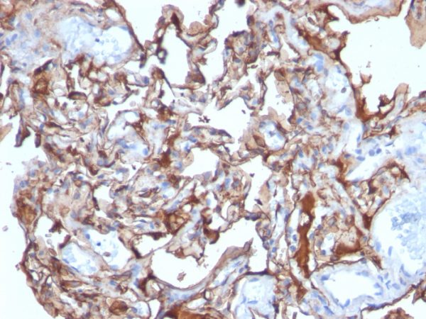 Formalin-fixed, paraffin-embedded human Melanoma stained with MCAM Mouse Monoclonal Antibody (MCAM/1101).
