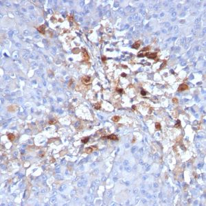Formalin-fixed, paraffin-embedded human Melanoma stained with CD146 Monoclonal Antibody (C146/634)