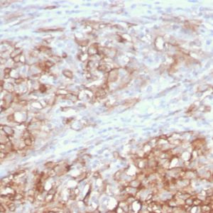 Formalin-fixed, paraffin-embedded human Melanoma stained with MCAM Mouse Monoclonal Antibody (MCAM/3046).