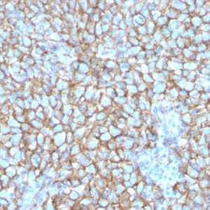 Formalin-fixed, paraffin-embedded human Melanoma stained with MCAM Mouse Monoclonal Antibody (MCAM/3048).