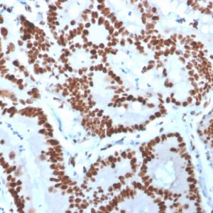 Formalin-fixed, paraffin-embedded human Colon Carcinoma stained with MCM6 Mouse Monoclonal Antibody (MCM6/3000).