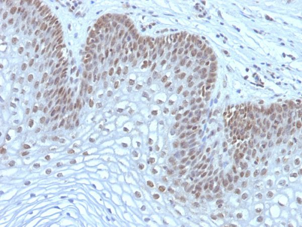 Formalin-fixed, paraffin-embedded human Cervical Carcinoma stained with MAP3K1 Mouse Monoclonal Antibody (2F6).