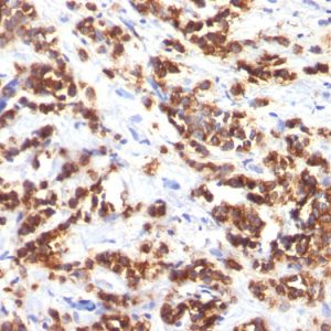 Formalin-fixed, paraffin-embedded human Breast Carcinoma stained with Milk Fat Globule Monoclonal Antibody (MFG-06)