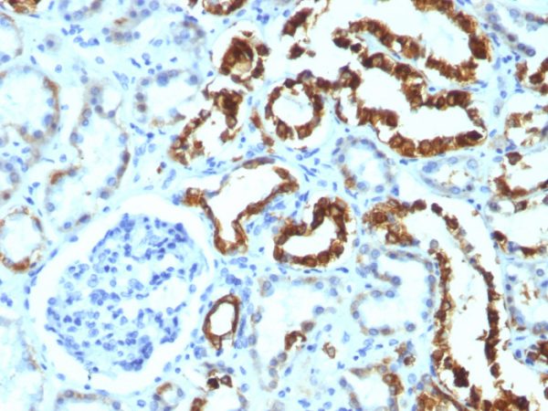 Formalin-fixed, paraffin-embedded human Renal Cell Carcinoma stained with Milk Fat Globule Monoclonal Antibody (MFG-06)