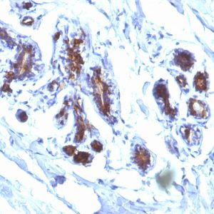 Formalin-fixed, paraffin-embedded human Breast Carcinoma stained with Milk Fat Globule Monoclonal Antibody (EDM45)
