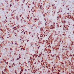 Formalin-fixed, paraffin-embedded human breast adenocarcinoma stained with Mammaglobin-Monospecific Mouse Monoclonal Antibody (MGB/2000).