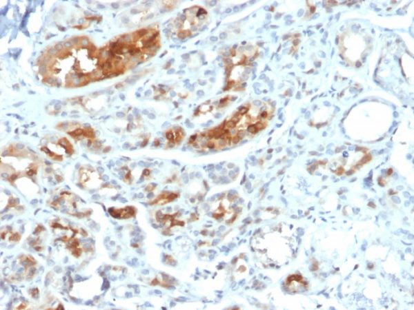Formalin-fixed, paraffin-embedded human breast carcinoma stained with Mammaglobin-Monospecific Mouse Monoclonal Antibody (MGB/2000).