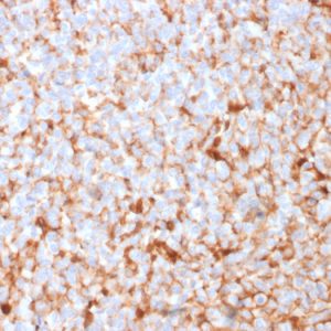 Formalin-fixed, paraffin-embedded human Breast Carcinoma stained with Monospecific Mouse Monoclonal Antibody (SPM518) to Mammaglobin.