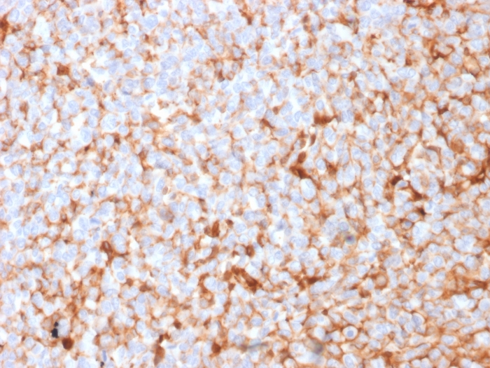 Formalin-fixed, paraffin-embedded human Breast Carcinoma stained with Monospecific Mouse Monoclonal Antibody (SPM518) to Mammaglobin. Mammaglobin (SCGB2A2) (Breast Cancer Marker) Antibody