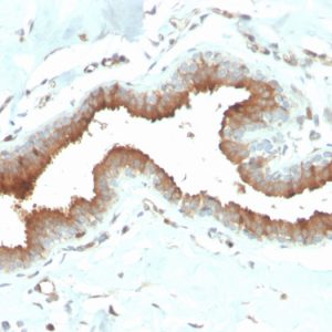 Formalin-fixed, paraffin-embedded human breast carcinoma stained with Mammaglobin Mouse Monoclonal Antibody (MGB/2704).