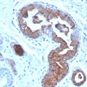 Formalin-fixed, paraffin-embedded human breast carcinoma stained with Mammaglobin Mouse Monoclonal Antibody (MGB/4056).
