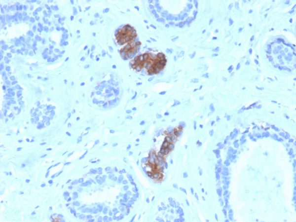 Formalin-fixed, paraffin-embedded human breast carcinoma stained with Mammaglobin Mouse Monoclonal Antibody (MGB/4056).