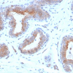 Formalin-fixed, paraffin-embedded human breast carcinoma stained with Mammaglobin Recombinant Mouse Monoclonal Antibody (rMGB/4299).