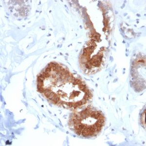 Formalin-fixed, paraffin-embedded human breast carcinoma stained with Rabbit Recombinant Monoclonal Antibody (MGB/2123R) to Mammaglobin