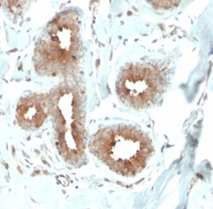 Formalin-fixed, paraffin-embedded human breast carcinoma stained with Mammaglobin Recombinant Rabbit Monoclonal Antibody (MGB/4057R). HIER: Tris/EDTA, pH9.0, 45min. 2°C: HRP-polymer, 30min. DAB, 5min.