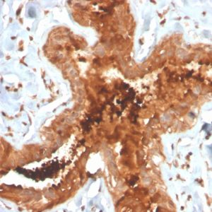 Formalin-fixed, paraffin-embedded human breast carcinoma stained with Mammaglobin Recombinant Rabbit Monoclonal Antibody (MGB/4058R).