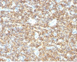 Formalin-fixed, paraffin-embedded human Ewing&apos;s Sarcoma stained with CD99 Mouse Monoclonal Antibody (HO36-1.1).