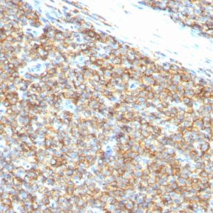Formalin-fixed, paraffin-embedded human Ewing&apos;s Sarcoma stained with CD99 Monoclonal Antibody (12E7).